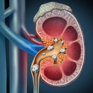 kidney stone kidney stone